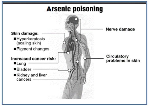 arsenic poisoning