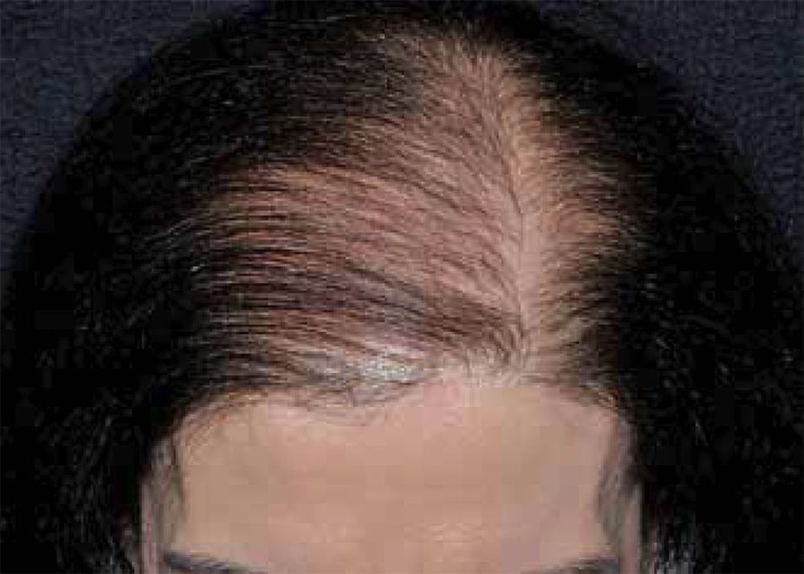 thinning hair loss from hard water